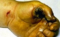 Entrance Wound to Worker's Hand from Burn From Hot Tool