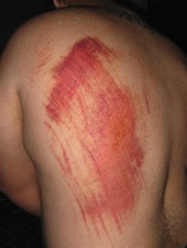 Road Rash Injury from Motorcycle Accident