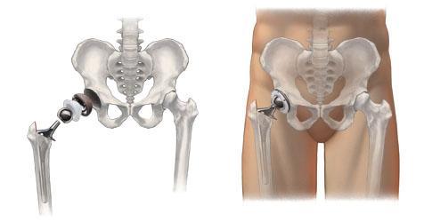 Hip Injury