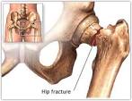 Hip Injury