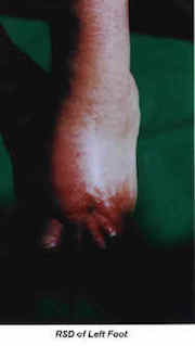 Foot Injury