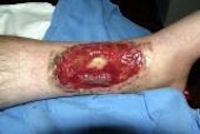 Severe Burn Injury