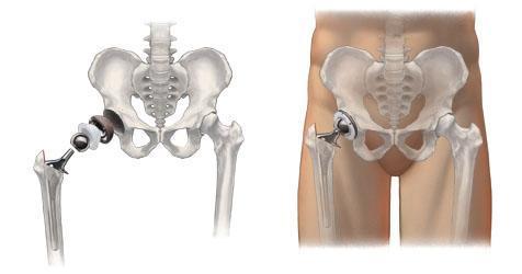 Hip Injury